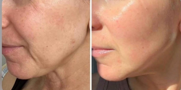 radiofréquence fractionnée (rf)