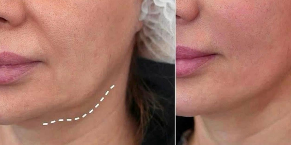 radiofréquence fractionnée (rf)