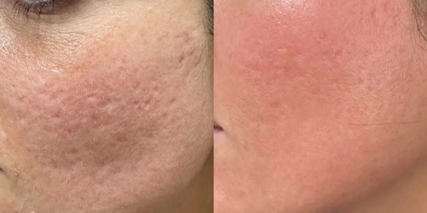 radiofréquence fractionnée (rf)