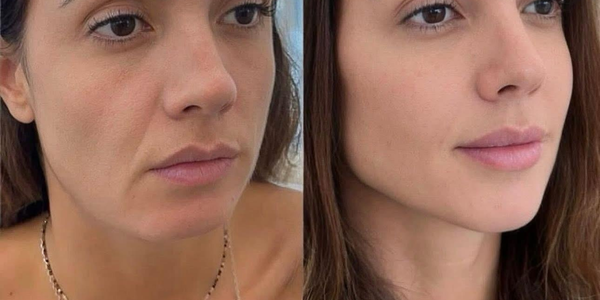 radiofréquence fractionnée (rf)