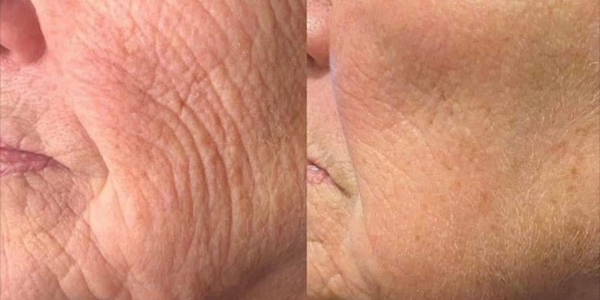 radiofréquence fractionnée (rf)