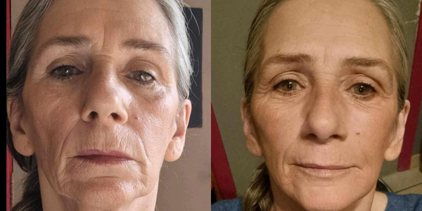 radiofréquence fractionnée (rf)