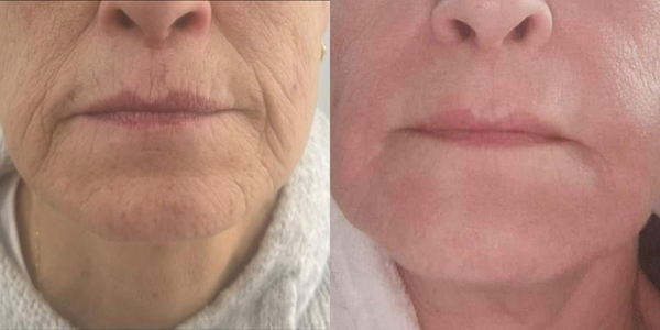 radiofréquence fractionnée (rf)