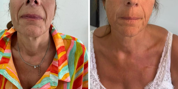 radiofréquence fractionnée (rf)