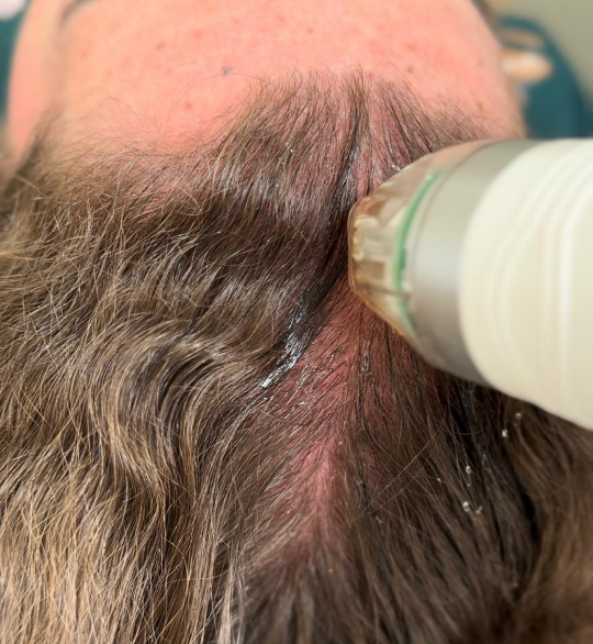 Hairneedling coselman