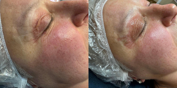 PhiIon Pro Plasma Lift cosmelan (1)