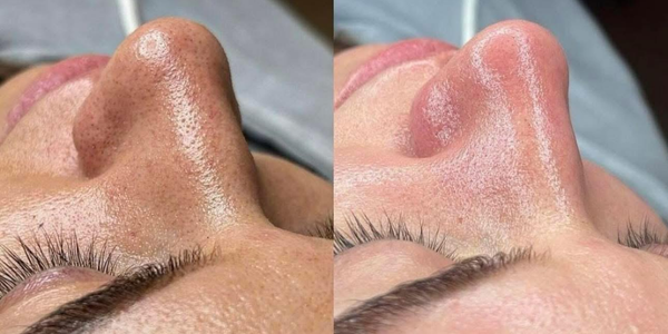 Hydradermabrasion cosmelan