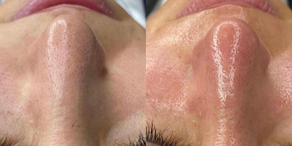 Hydradermabrasion cosmelan (2)