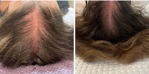 Hairneedling hairneedling