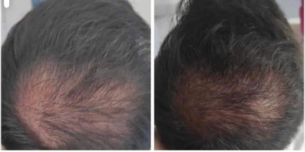 Hairneedling hairneedling